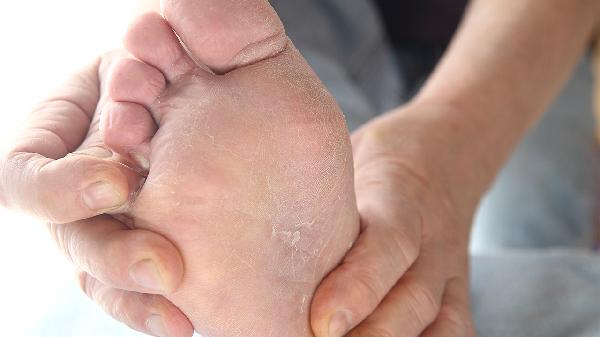 哪些方法能預(yù)防手足癬發(fā)生
