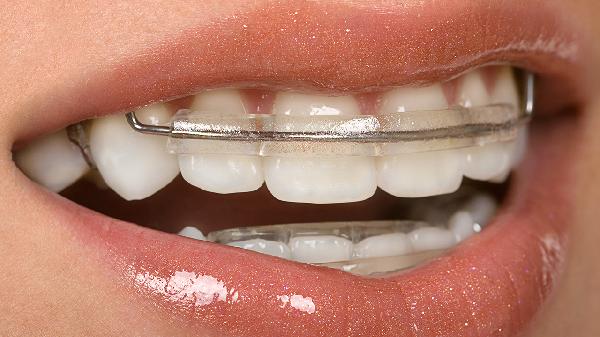 戴上牙套后的注意事項