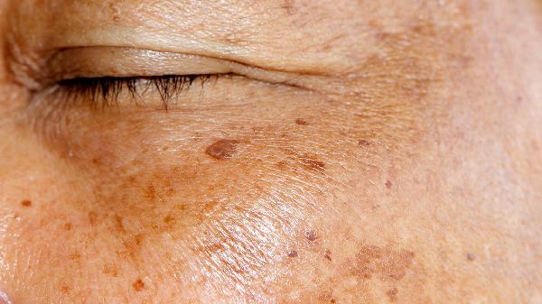 什么是敏感肌皮膚