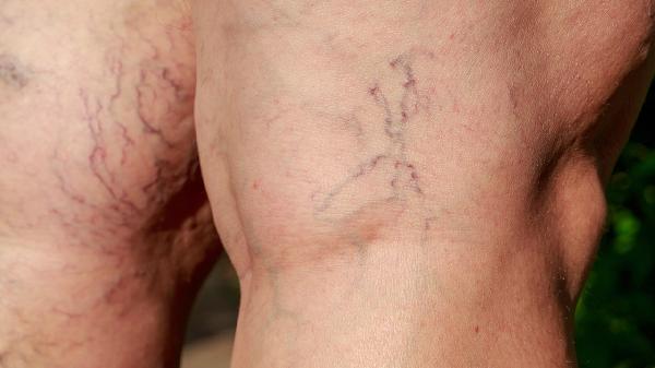 十二指肠降部粘膜充血水肿什么原因