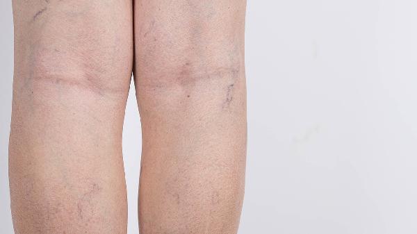 小腿粗怎么瘦小腿