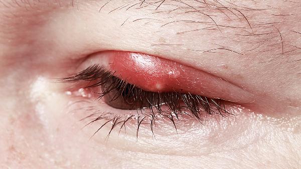 小兒霰粒腫的癥狀有哪些