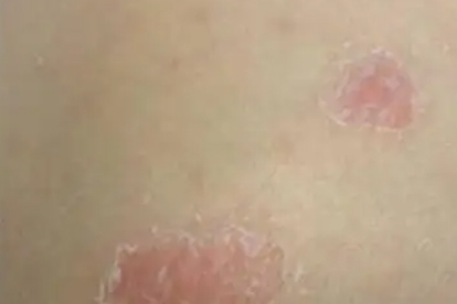 點狀銀屑病可以吃海參嗎