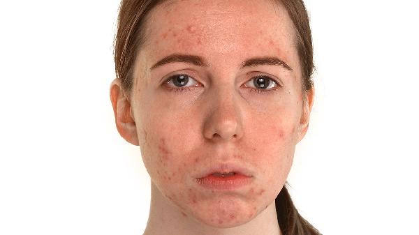 紅血絲面部怎么護理