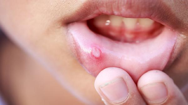 5個(gè)小妙招巧治口腔潰瘍