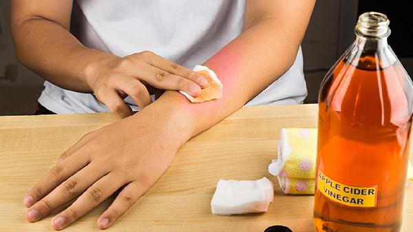 燒傷能用冰水浸泡緩解嗎