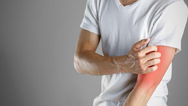 鹽酸特比萘芬凝膠能治日光性皮炎嗎