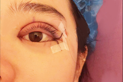 雙眼皮手術(shù)修復(fù)前注意哪些