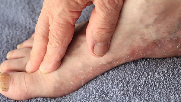 腳癬是怎么形成的