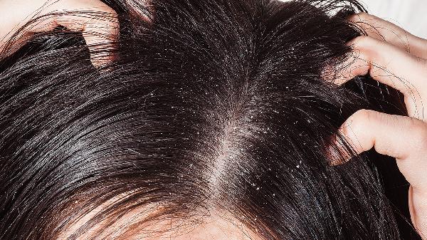 兒童頭皮屑多怎么辦