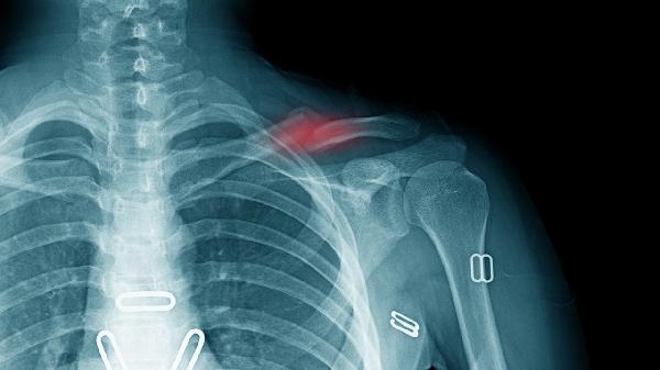 肩膀鎖骨骨折怎么治療