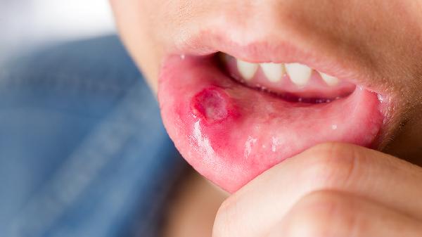 糜爛性賁門(mén)口炎嚴重嗎