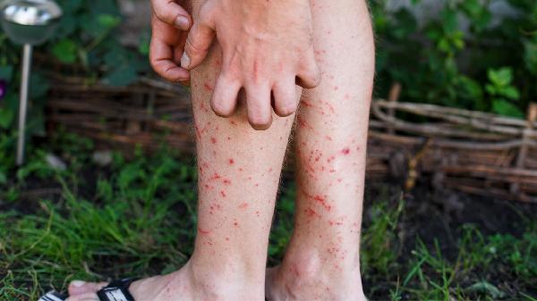 冷空氣過敏性蕁麻疹怎么辦