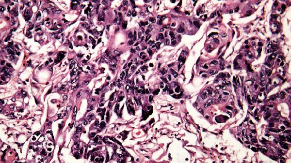 鼻病毒陽性需要霧化嗎