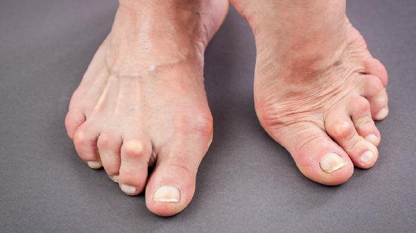 拐棗泡酒能治痛風(fēng)嗎