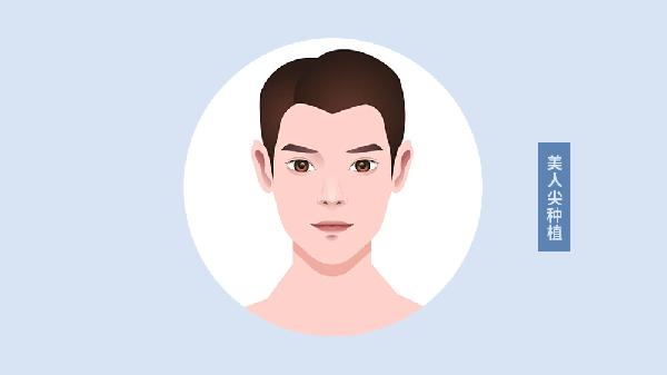 做美人尖種植費用