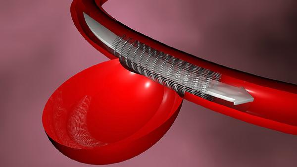 什么是先天性血管畸形癥