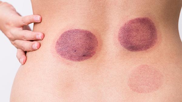 拔罐黑紫色什么時候能下去