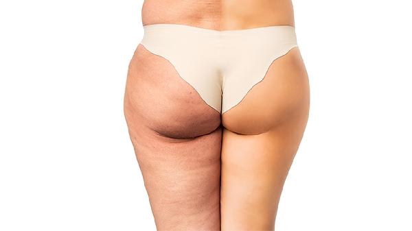 臀部突然變大這是什么原因