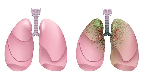 白肺的克星第一名 白肺可以治愈嗎