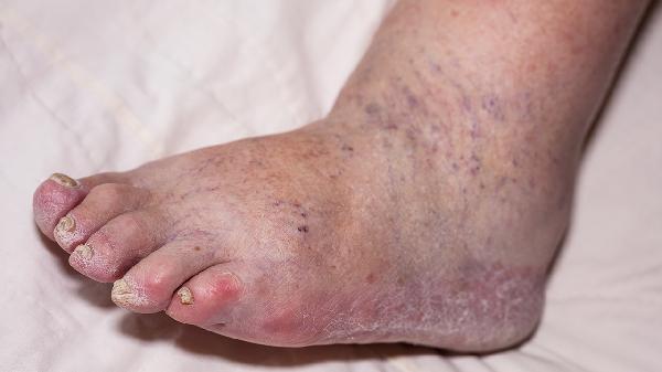 海绵体供血不足治疗最佳方法