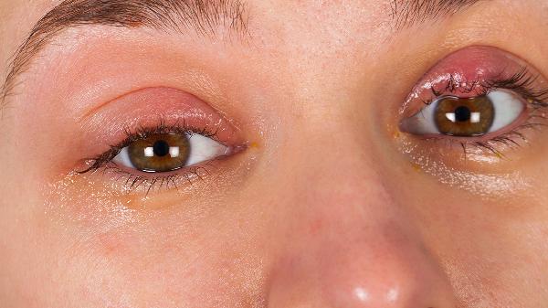 糖尿病并发症眼睛的症状