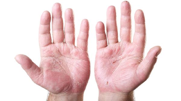 换季手脱皮是什么原因