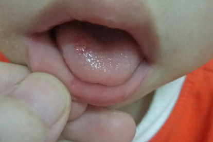 老年人口腔潰瘍吃點(diǎn)什么藥