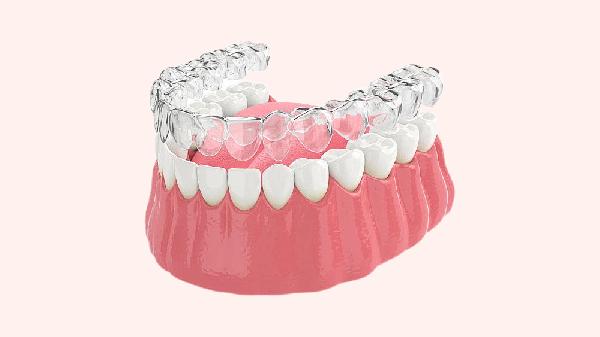 天包地牙齒矯正多少錢