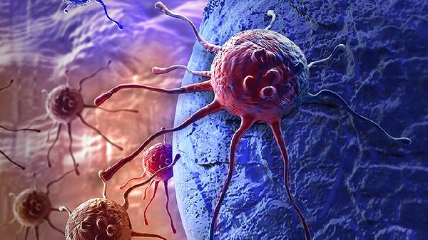 支氣管鱗狀細(xì)胞癌怎么治療效果好