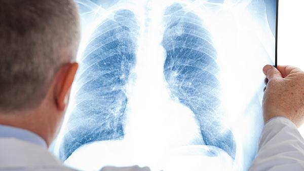 間質(zhì)性肺炎肺纖維化能活多久呀