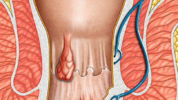 腸膜血管變粗動手術能恢復嗎