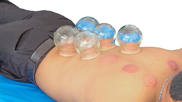 拔罐發(fā)癢是不是濕氣太重