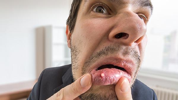 小兒消化潰瘍癥狀有哪些