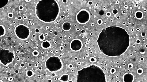 成人型粒層細(xì)胞瘤復(fù)發(fā)率高嗎