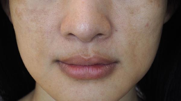 大腿內側有白色斑塊怎么回事