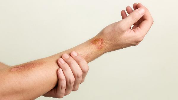 手臂拉傷了怎么緩解疼痛