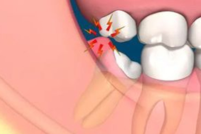 長智齒發(fā)燒會持續(xù)多久