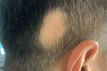 兒童斑禿一般多久能好