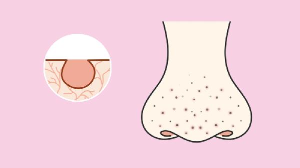 光子嫩膚能去黑頭能收縮毛孔嗎