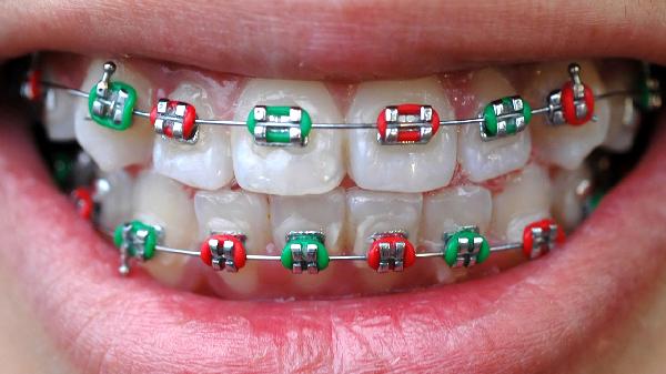 牙套刮到口腔内壁什么情况