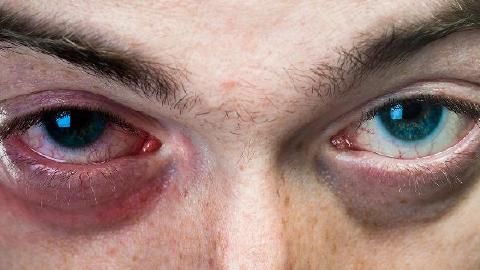 做完眼袋多久才消腫