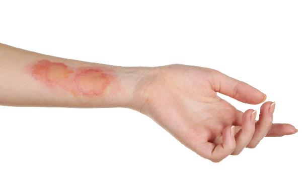 燙傷后3天傷口周?chē)€是發(fā)紅