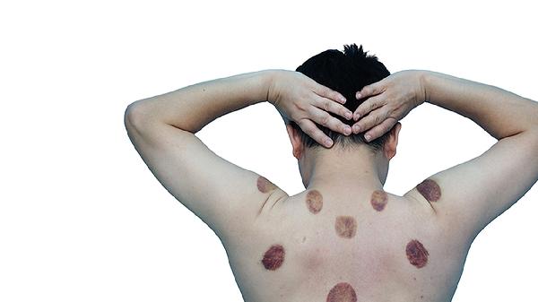 男人拔罐后能同房嗎