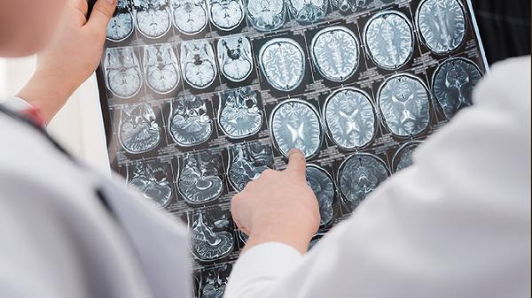 脑溢血后腿脚麻木多久恢复