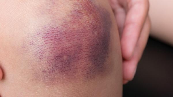 買(mǎi)的生豬蹄有淤青能吃嗎