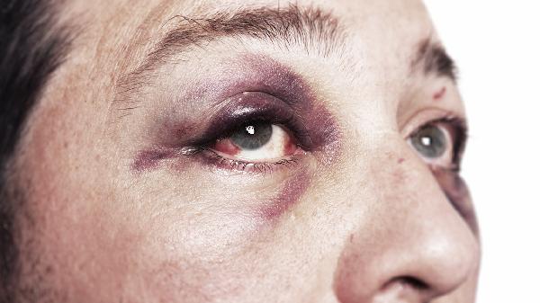 做眼瞼內(nèi)翻矯正術(shù)后效果