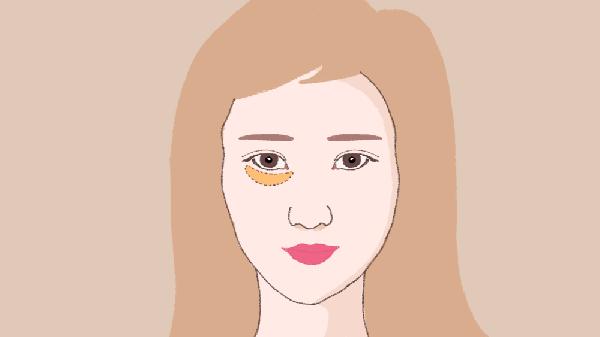 自體脂肪填充淚溝怎么修復(fù)