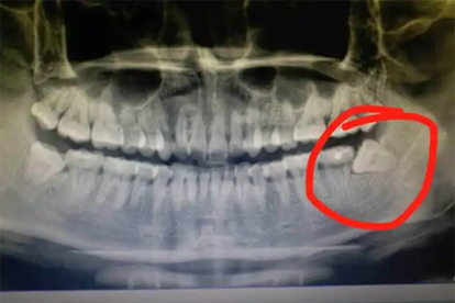 怎樣判斷是智齒發(fā)炎還是上火