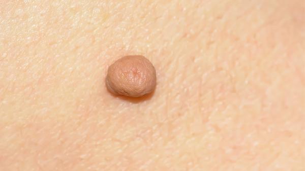 腸系膜纖維瘤8厘米嚴(yán)重嗎